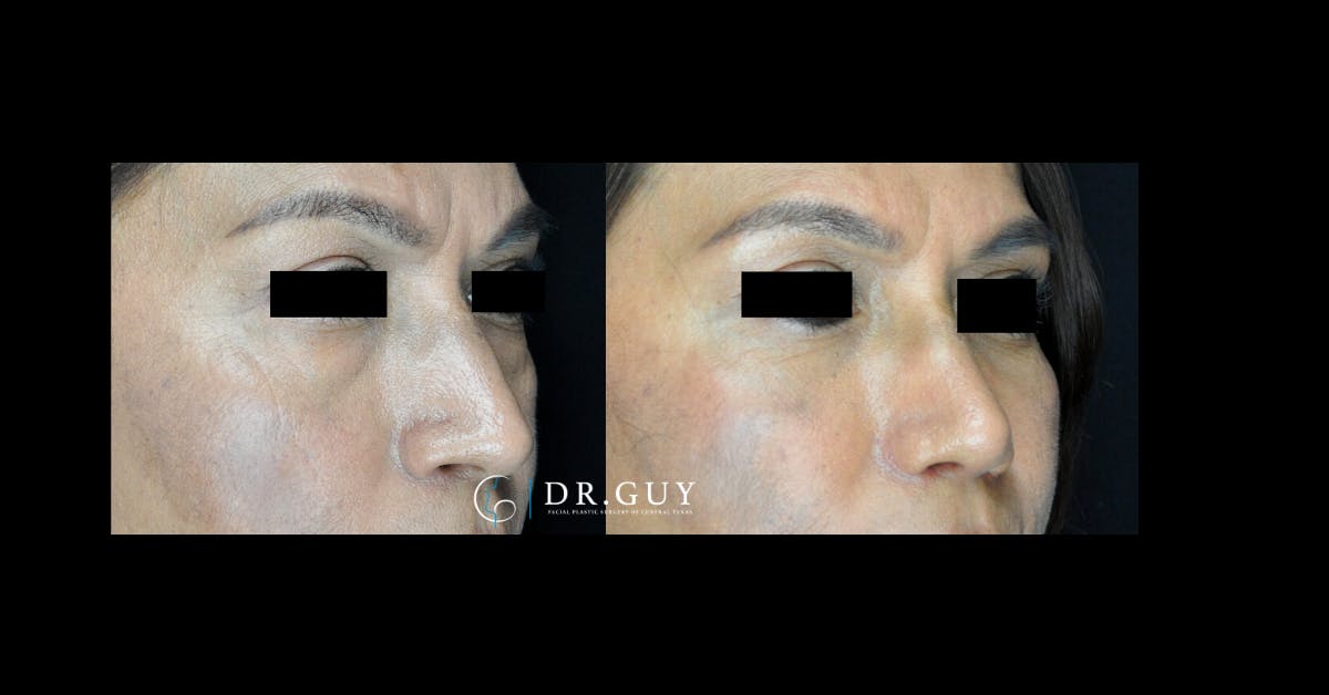 Fat Grafting Before & After Gallery - Patient 191699 - Image 2
