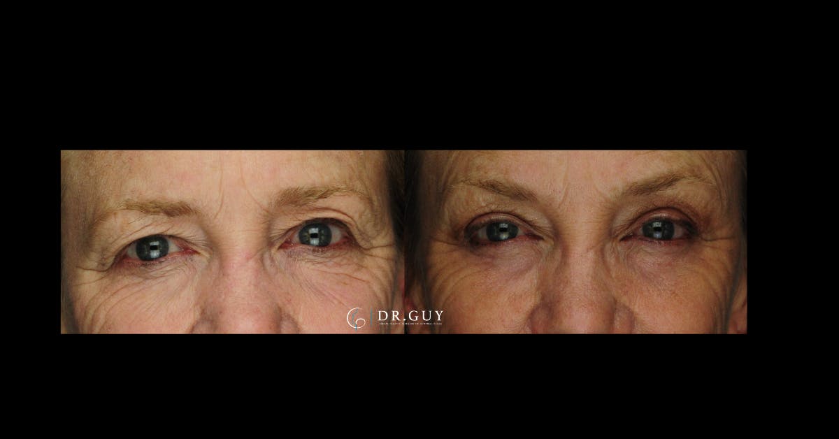 Upper Blepharoplasty Before & After Gallery - Patient 322359 - Image 3