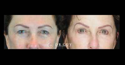 Fat Grafting Before & After Gallery - Patient 169831 - Image 1