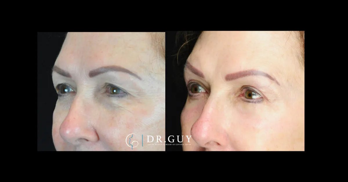 Fat Grafting Before & After Gallery - Patient 169831 - Image 2