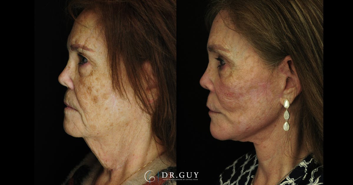 Laser Before & After Gallery - Patient 251658 - Image 3