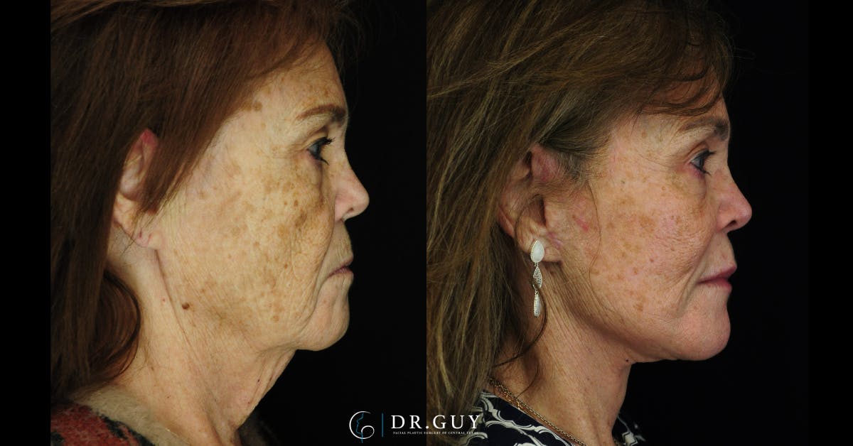 Laser Before & After Gallery - Patient 251658 - Image 5