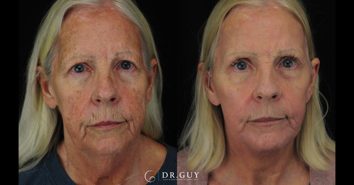 Laser Before & After Gallery - Patient 348138 - Image 1