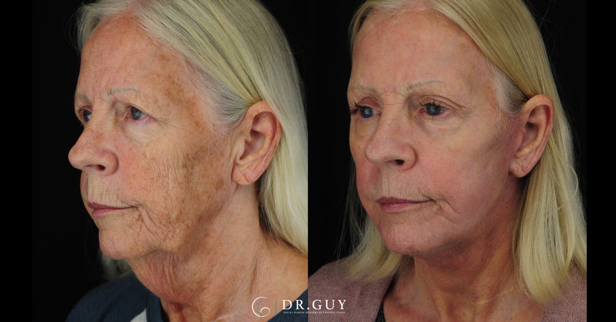 Laser Before & After Gallery - Patient 348138 - Image 2