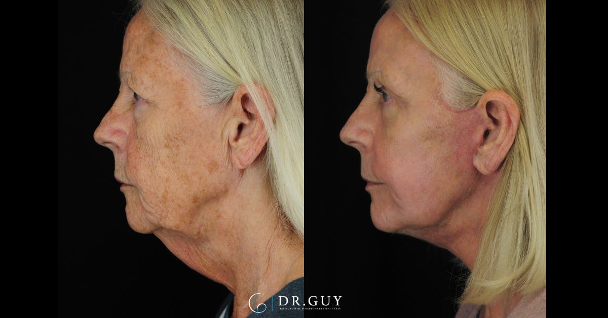 Laser Before & After Gallery - Patient 348138 - Image 3