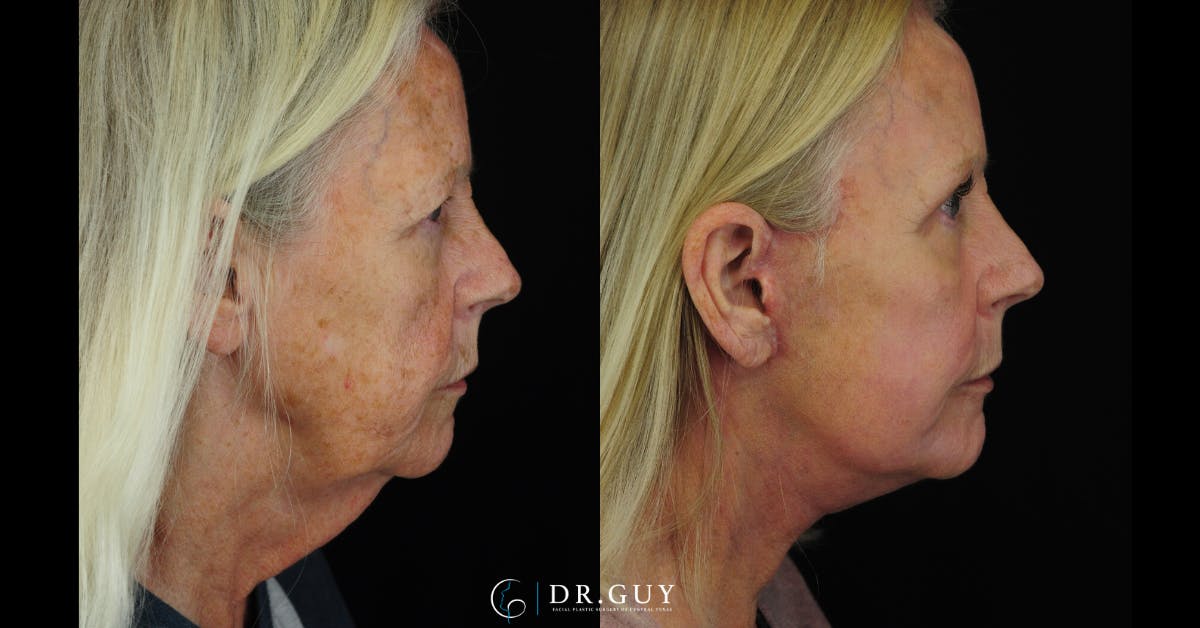 Laser Before & After Gallery - Patient 348138 - Image 5