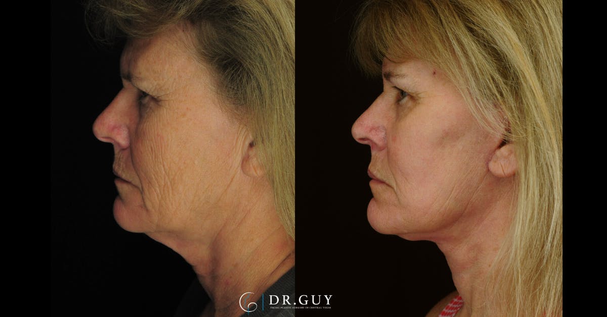 Laser Before & After Gallery - Patient 213737 - Image 5