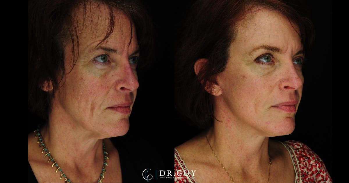 Laser Before & After Gallery - Patient 274281 - Image 2