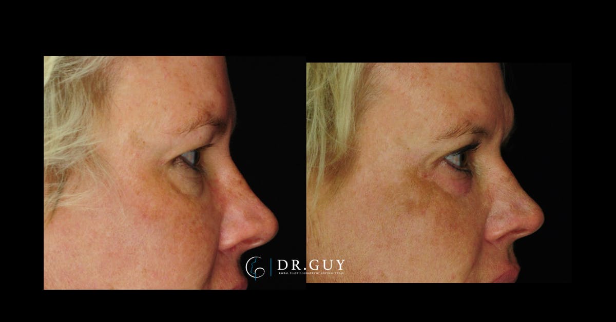 Upper Blepharoplasty Before & After Gallery - Patient 256947 - Image 5