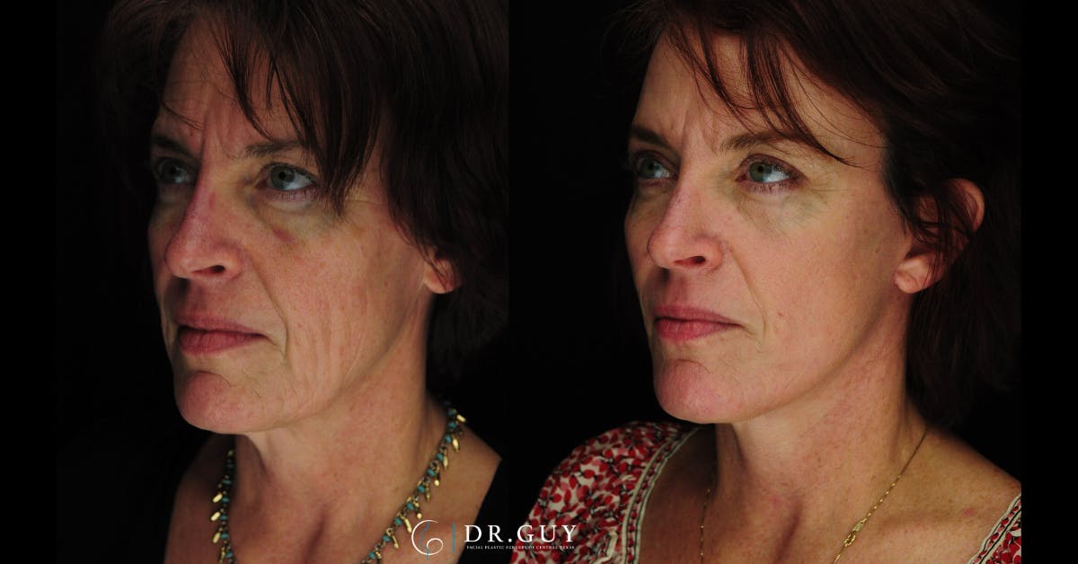 Laser Before & After Gallery - Patient 274281 - Image 4