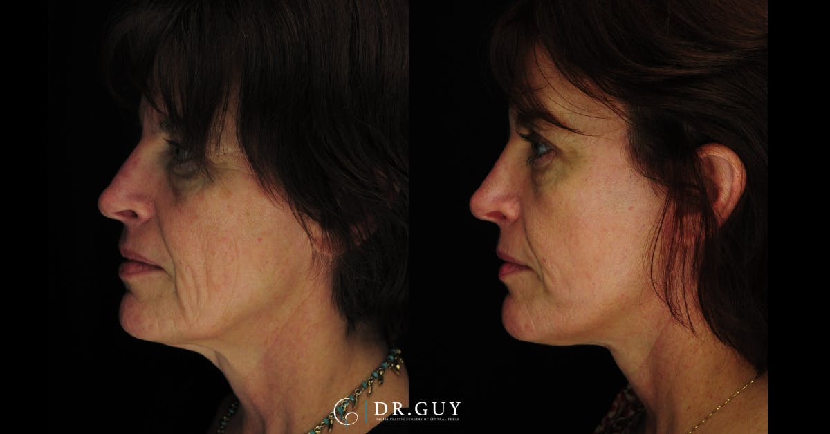 Laser Before & After Gallery - Patient 274281 - Image 5
