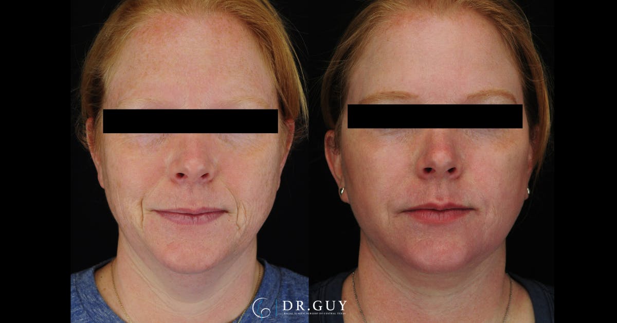 Laser Before & After Gallery - Patient 513630 - Image 1