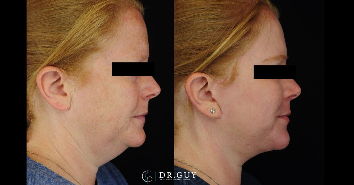 Laser Before & After Gallery - Patient 513630 - Image 2