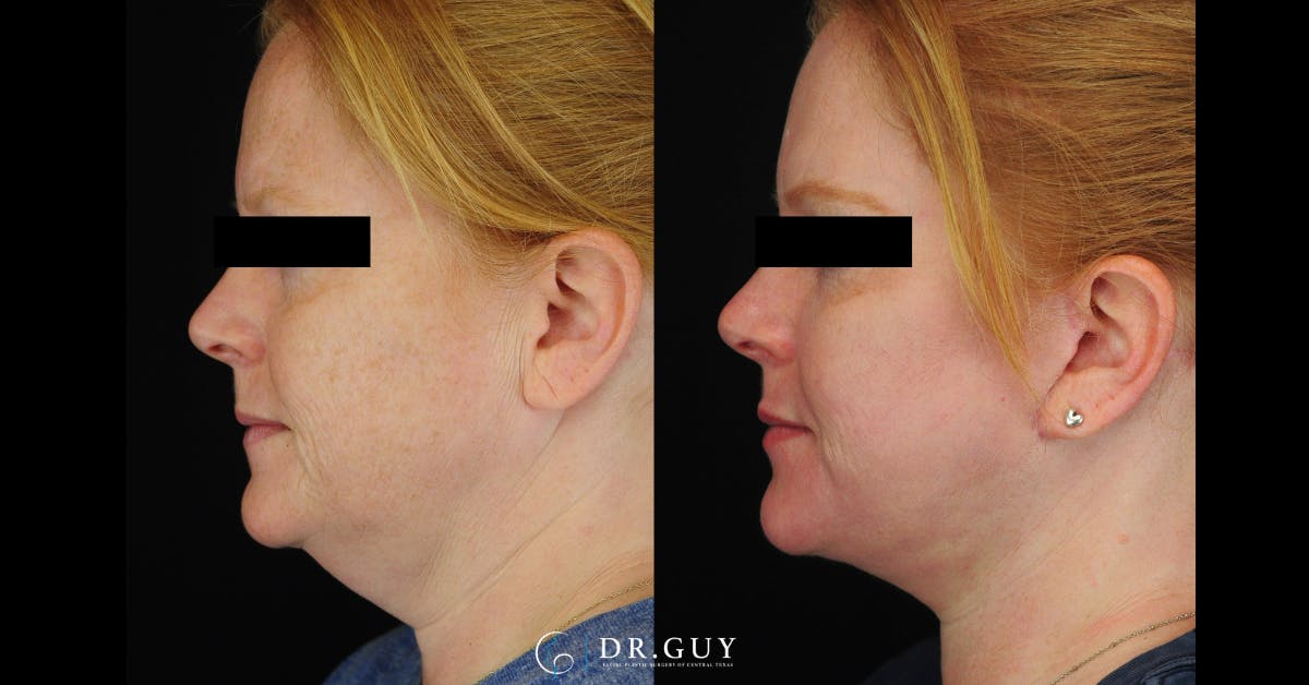 Laser Before & After Gallery - Patient 513630 - Image 3