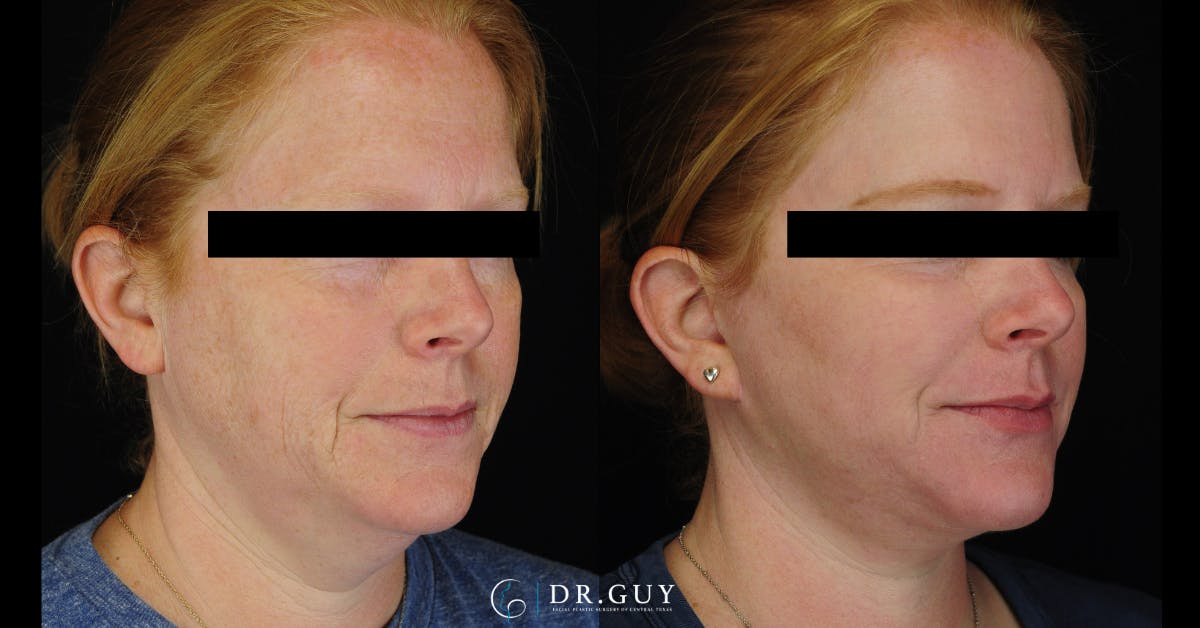 Laser Before & After Gallery - Patient 513630 - Image 4