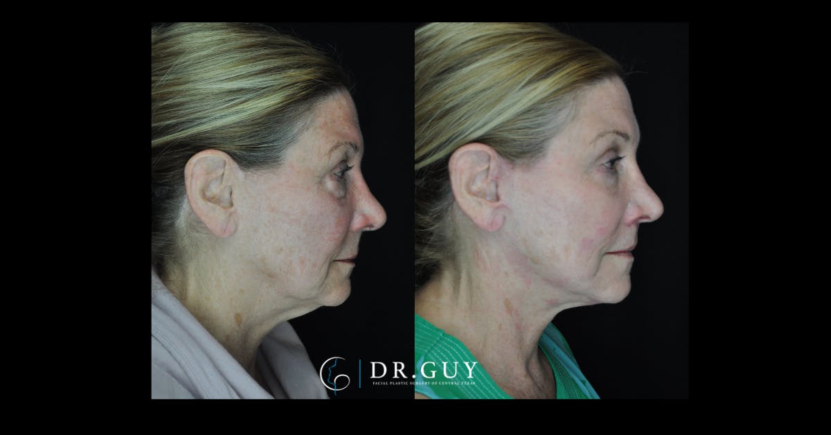 Laser Before & After Gallery - Patient 963987 - Image 2