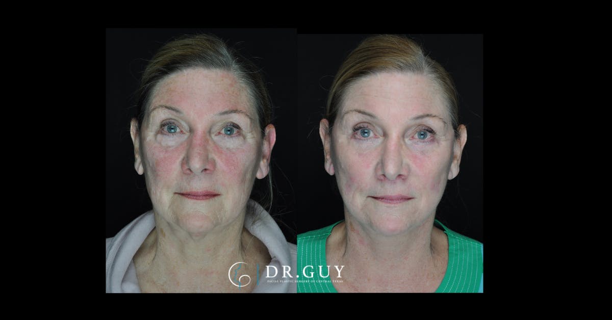 Laser Before & After Gallery - Patient 963987 - Image 3