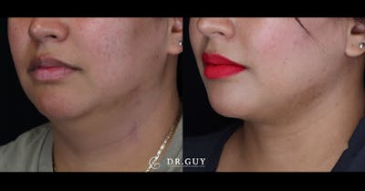 Neck Lift Before & After Gallery - Patient 145512 - Image 1