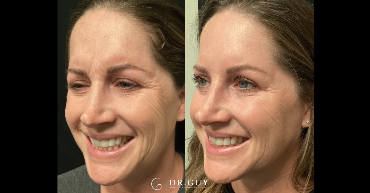 Fillers Before & After Gallery - Patient 863606 - Image 2