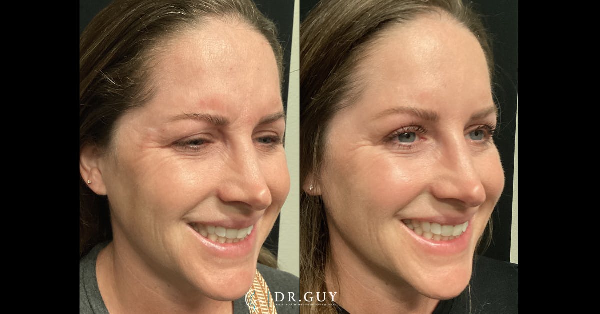Fillers Before & After Gallery - Patient 863606 - Image 1