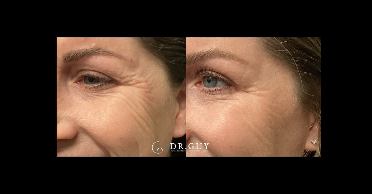 Fillers Before & After Gallery - Patient 863606 - Image 3