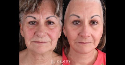 Laser Before & After Gallery - Patient 926567 - Image 1