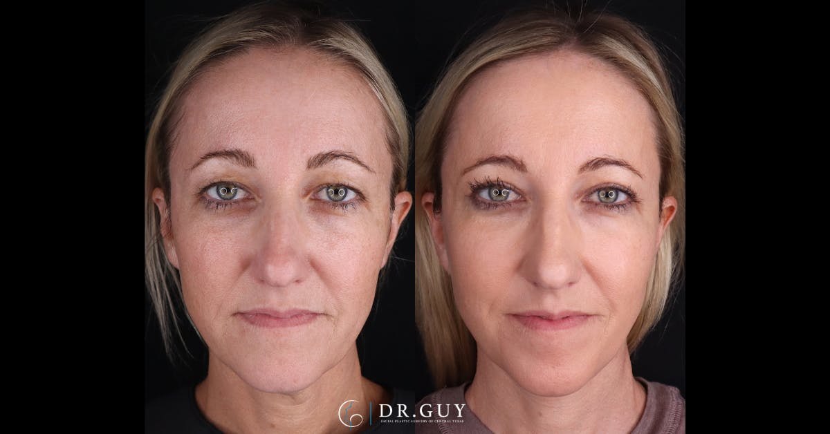 Neck Lift Before & After Gallery - Patient 105029 - Image 3