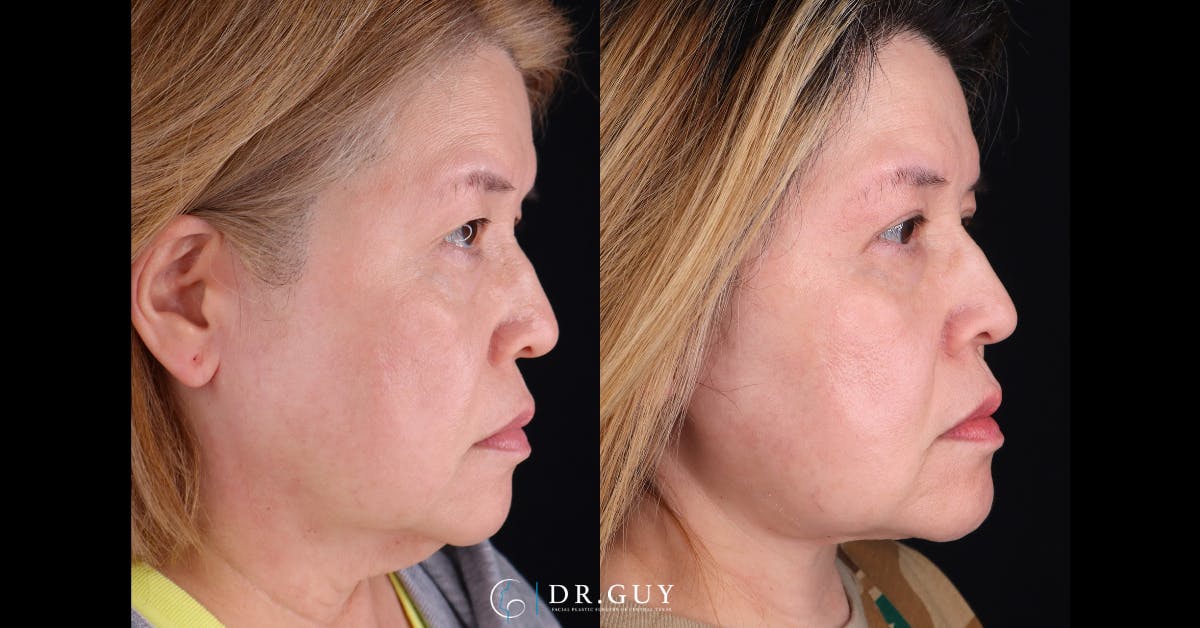 Neck Lift Before & After Gallery - Patient 276873 - Image 4
