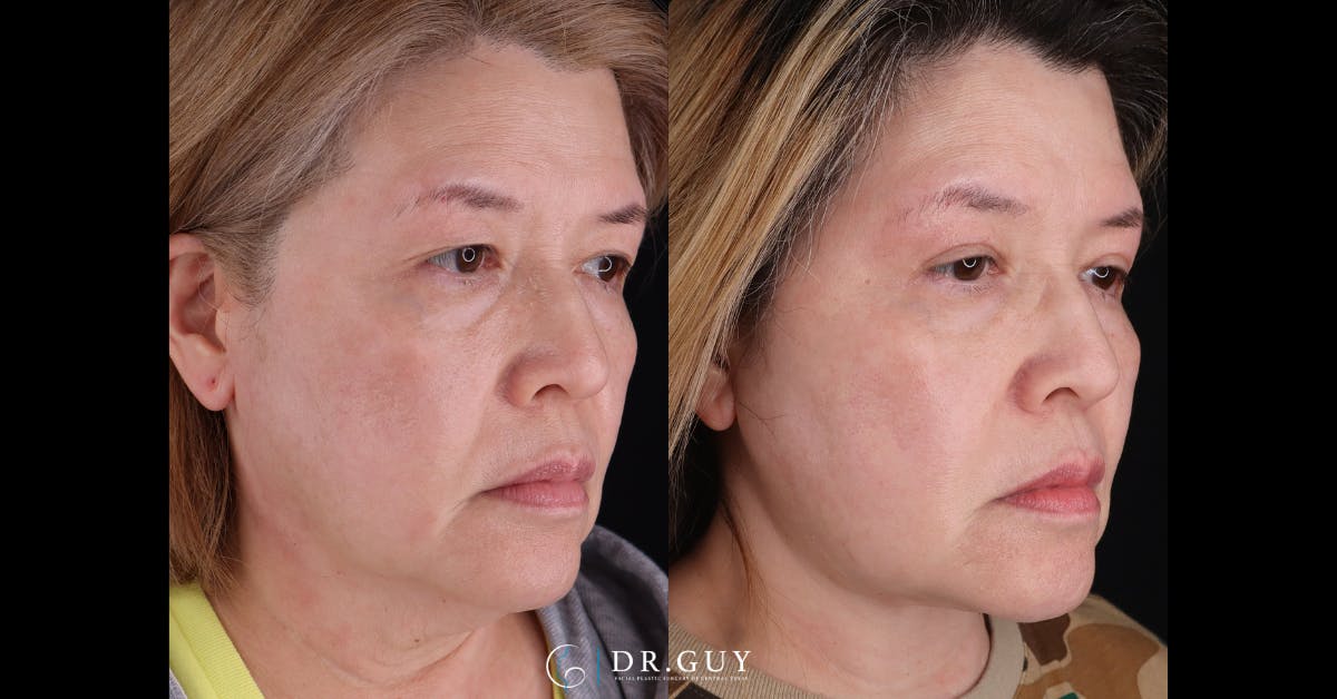 Neck Lift Before & After Gallery - Patient 276873 - Image 3