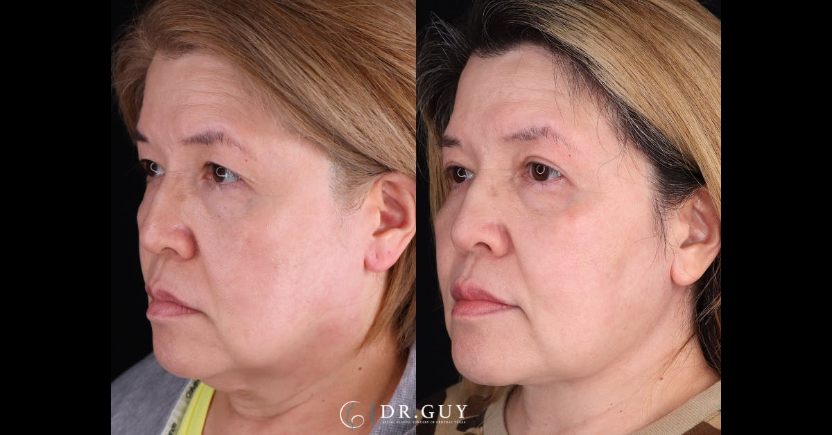 Neck Lift Before & After Gallery - Patient 276873 - Image 1