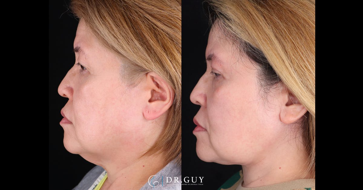 Neck Lift Before & After Gallery - Patient 276873 - Image 2