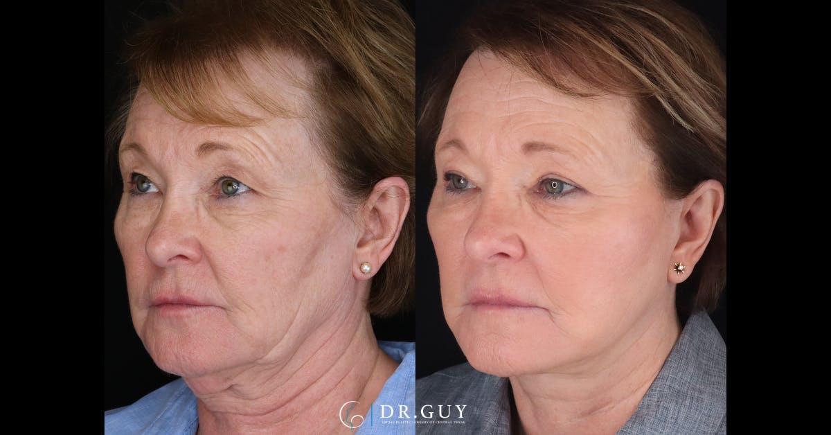 Laser Before & After Gallery - Patient 299737 - Image 3