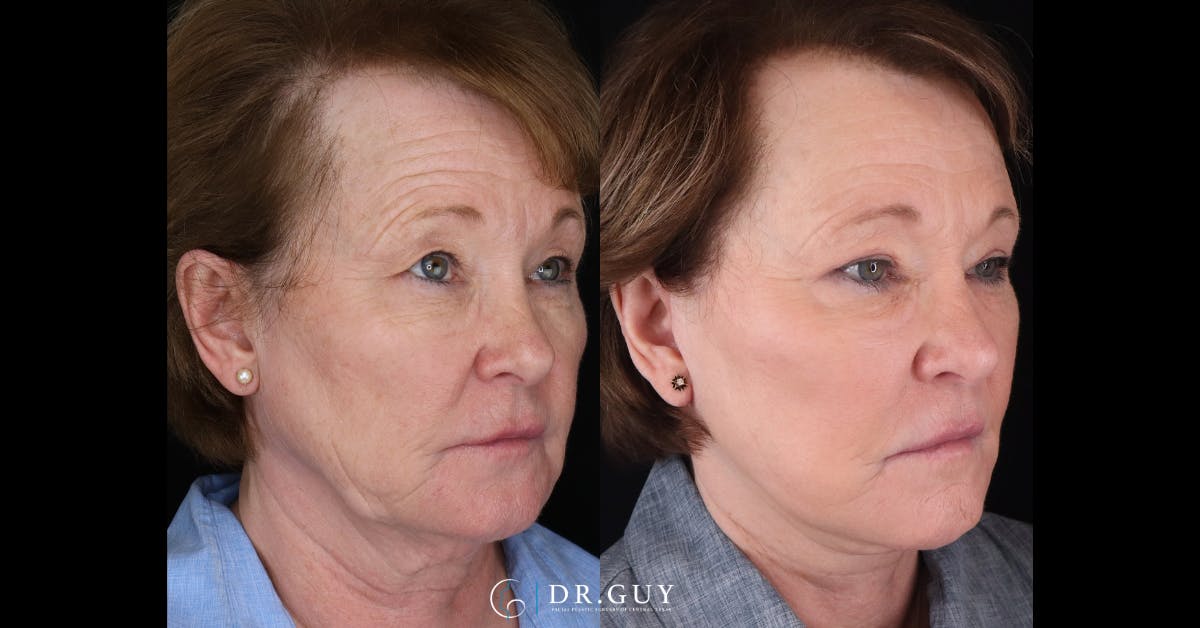 Laser Before & After Gallery - Patient 299737 - Image 2