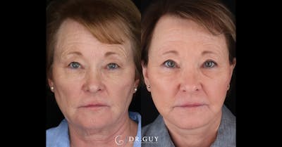Laser Before & After Gallery - Patient 299737 - Image 1