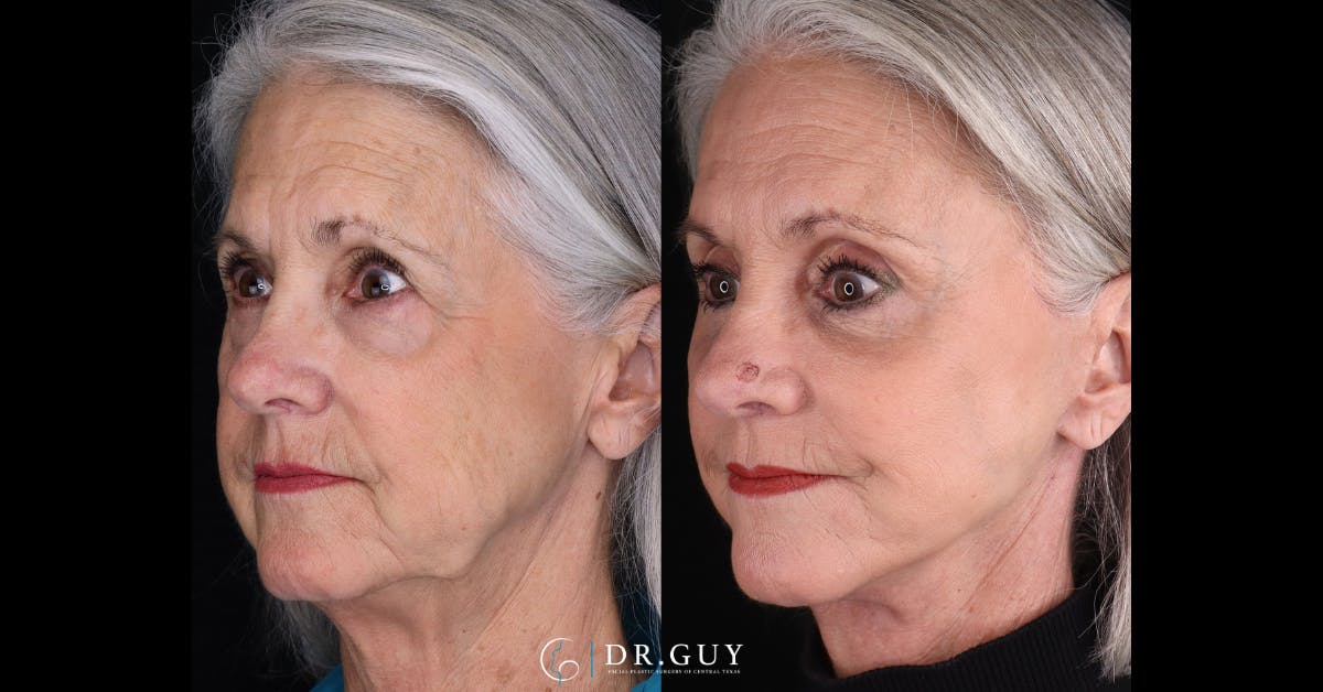 Lower Blepharoplasty Before & After Gallery - Patient 105776 - Image 4