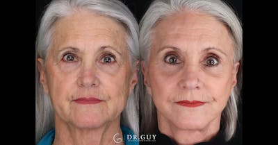 Browlift Before & After Gallery - Patient 102707 - Image 1