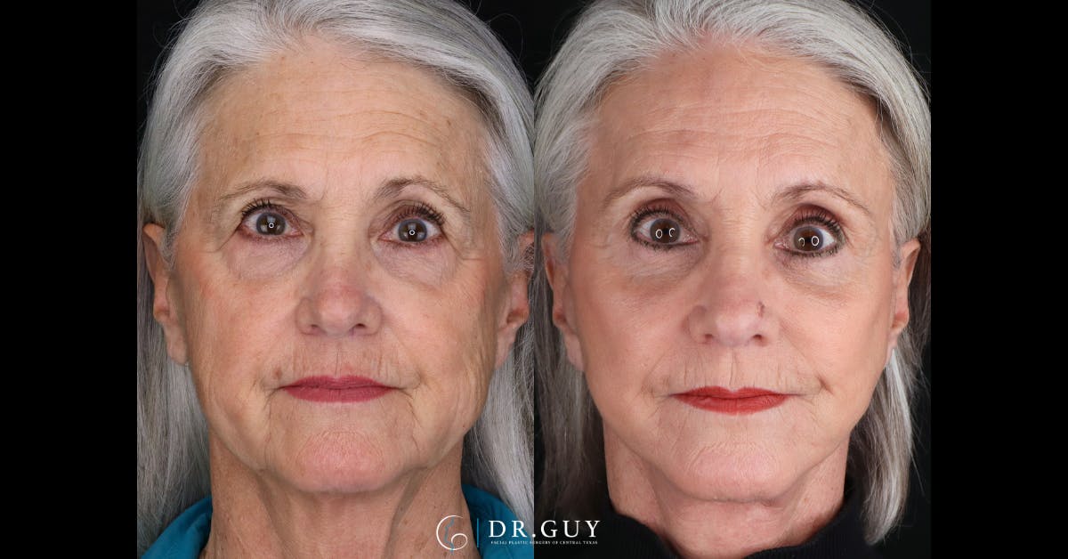 Lower Blepharoplasty Before & After Gallery - Patient 105776 - Image 1