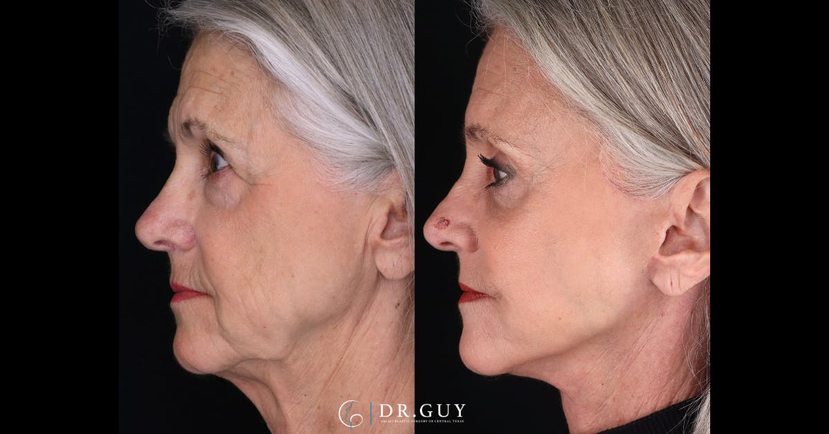 Lower Blepharoplasty Before & After Gallery - Patient 105776 - Image 5