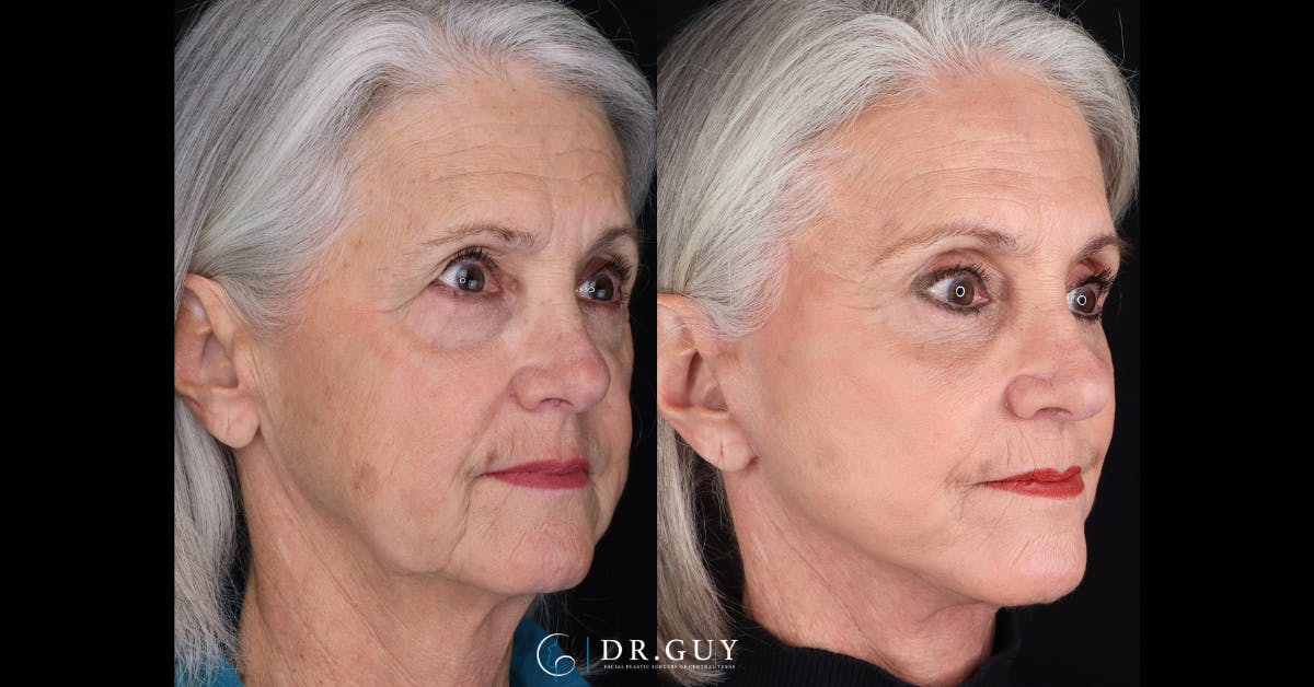 Lower Blepharoplasty Before & After Gallery - Patient 105776 - Image 2