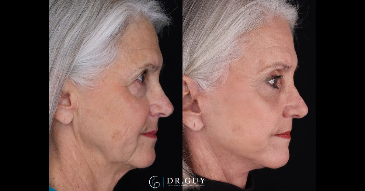 Lower Blepharoplasty Before & After Gallery - Patient 105776 - Image 3