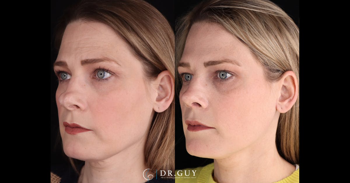Surgical Rhinoplasty Before & After Gallery - Patient 404277 - Image 1