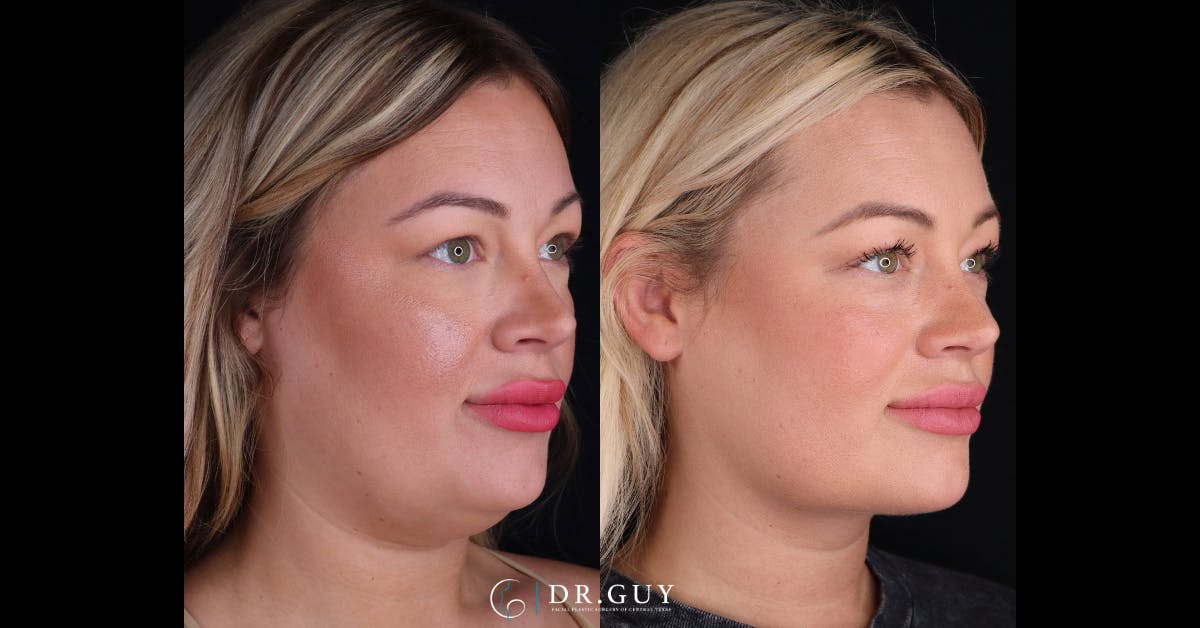 Platysmaplasty Before & After Gallery - Patient 111150 - Image 2
