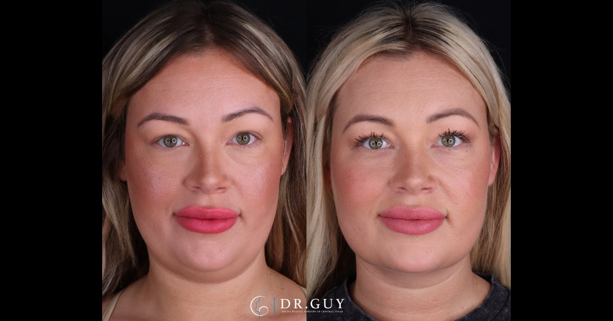 Platysmaplasty Before & After Gallery - Patient 111150 - Image 3