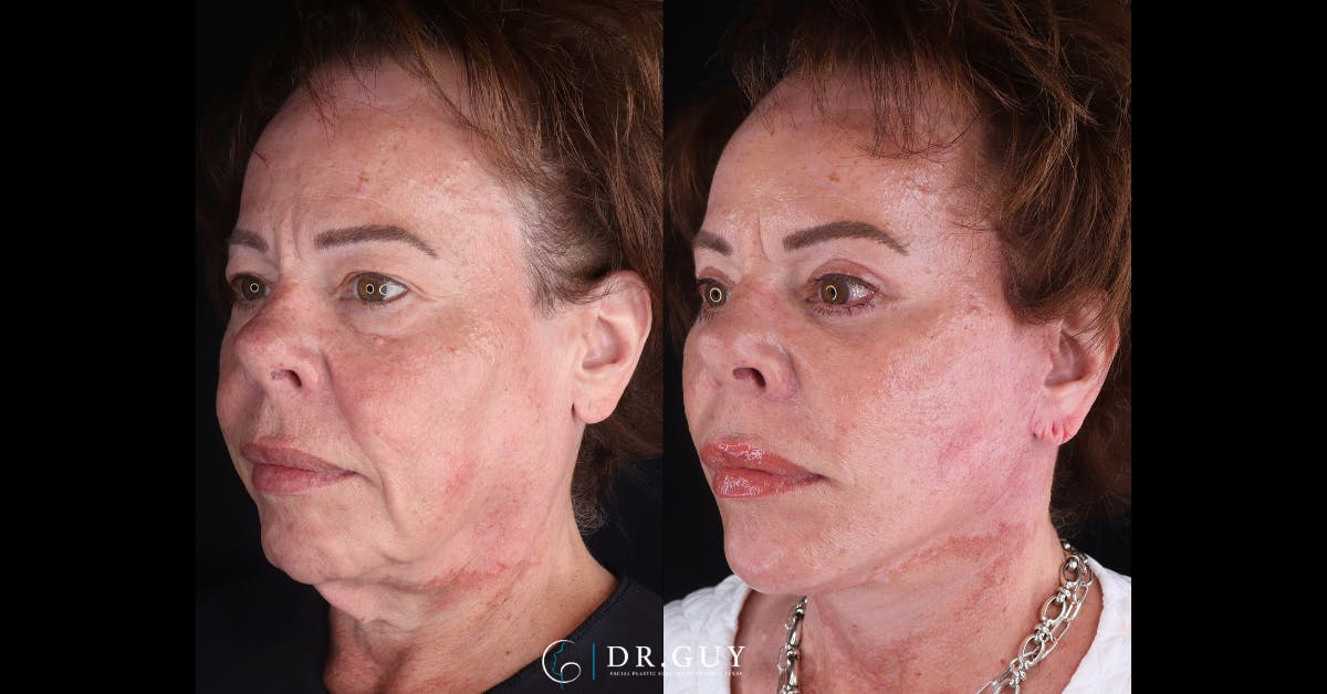 Upper Blepharoplasty Before & After Gallery - Patient 307044 - Image 3