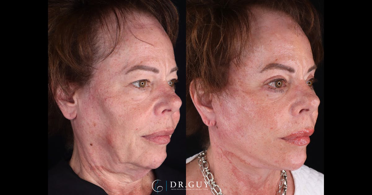 Upper Blepharoplasty Before & After Gallery - Patient 307044 - Image 2