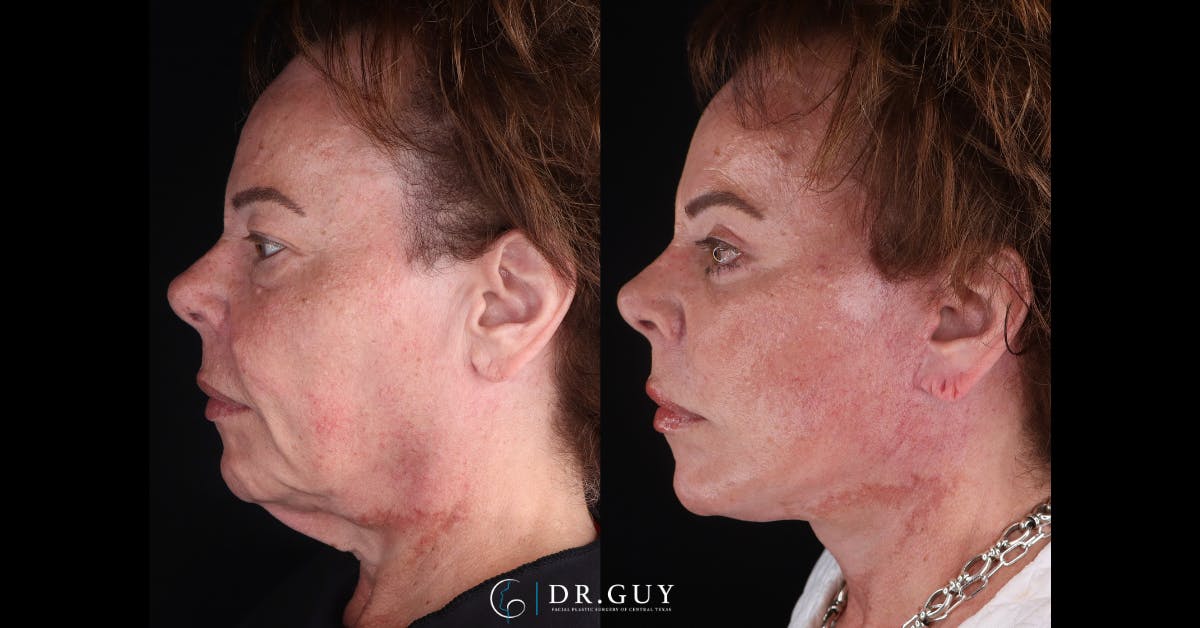 Upper Blepharoplasty Before & After Gallery - Patient 307044 - Image 4